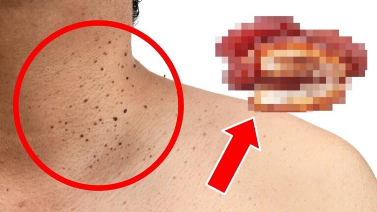 Questo semplice gesto alimentare può causare i porri… Scopri come evitarli facilmente!