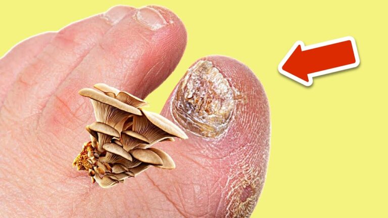 Elimina le infezioni fungine per sempre: 5 rimedi naturali che funzionano!